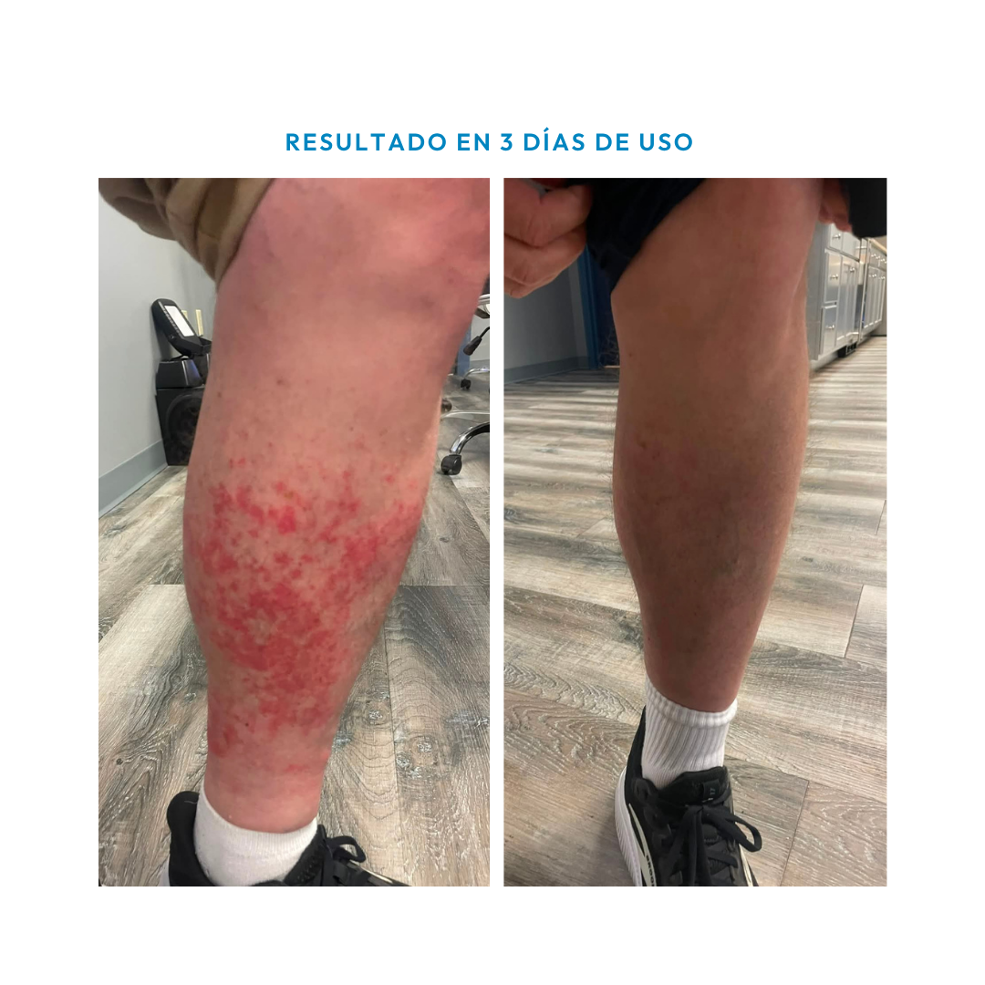 Crema Calmante para Irritaciones de la Piel